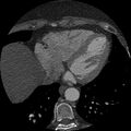 Anomalous origin of left circumflex artery from right coronary sinus (Radiopaedia 72563-83117 B 130).jpg
