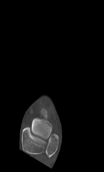 File:Anterior calcaneal process fracture (Radiopaedia 47384-51989 Axial bone window 8).png