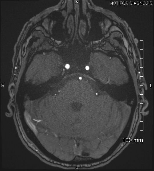 File:Anterior cerebral artery aneurysm (Radiopaedia 80683-94127 Axial MRA 64).jpg