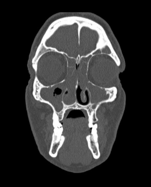 File:Antrochoanal polyp (Radiopaedia 79011-92169 Coronal bone window 62).jpg