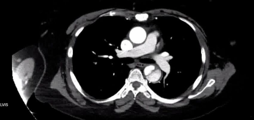 Aortic Dissection (Radiopaedia 85272-100847 A 20).jpg