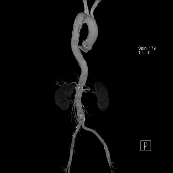 File:Aortic arch saccular aneurysm (Radiopaedia 19430-19457 A 10).jpg