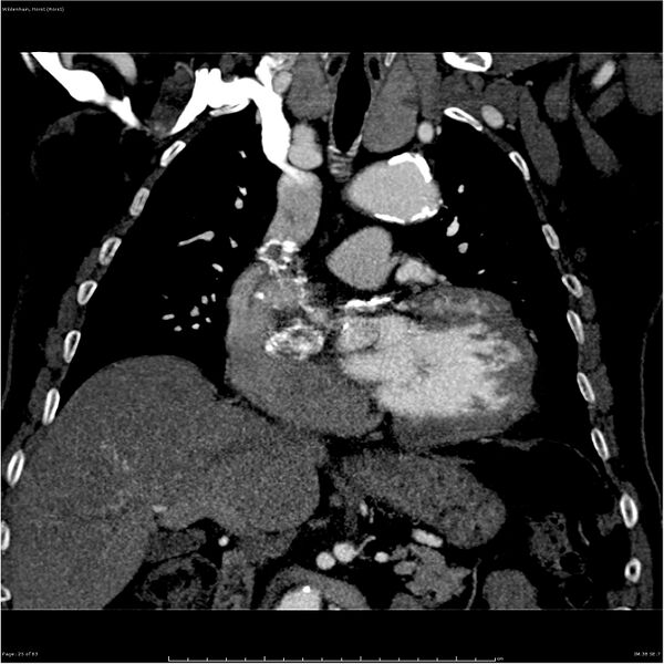 File:Aortic dissection - Stanford type A (Radiopaedia 26183-26315 A 25).jpg