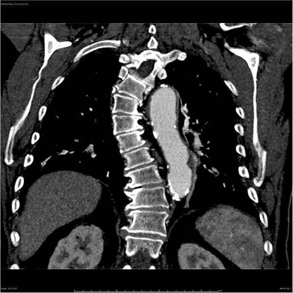File:Aortic dissection - Stanford type A (Radiopaedia 26183-26315 A 52).jpg