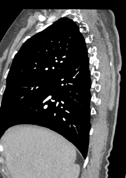File:Aortic dissection - Stanford type B (Radiopaedia 50171-55512 C 53).png