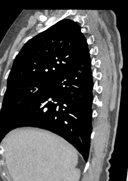 File:Aortic dissection - Stanford type B (Radiopaedia 50171-55512 C 54).png