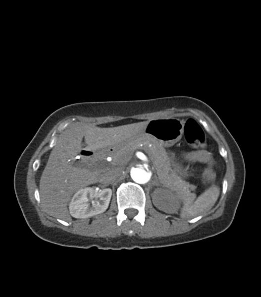 File:Aortic dissection with renal ischemia (Radiopaedia 76573-88338 A 63).jpg
