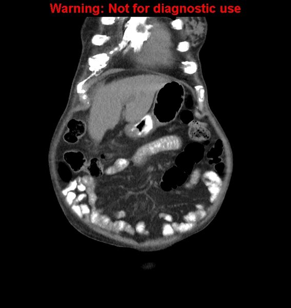 File:Aortic graft infection (Radiopaedia 44979-48907 non-contrast 9).jpg
