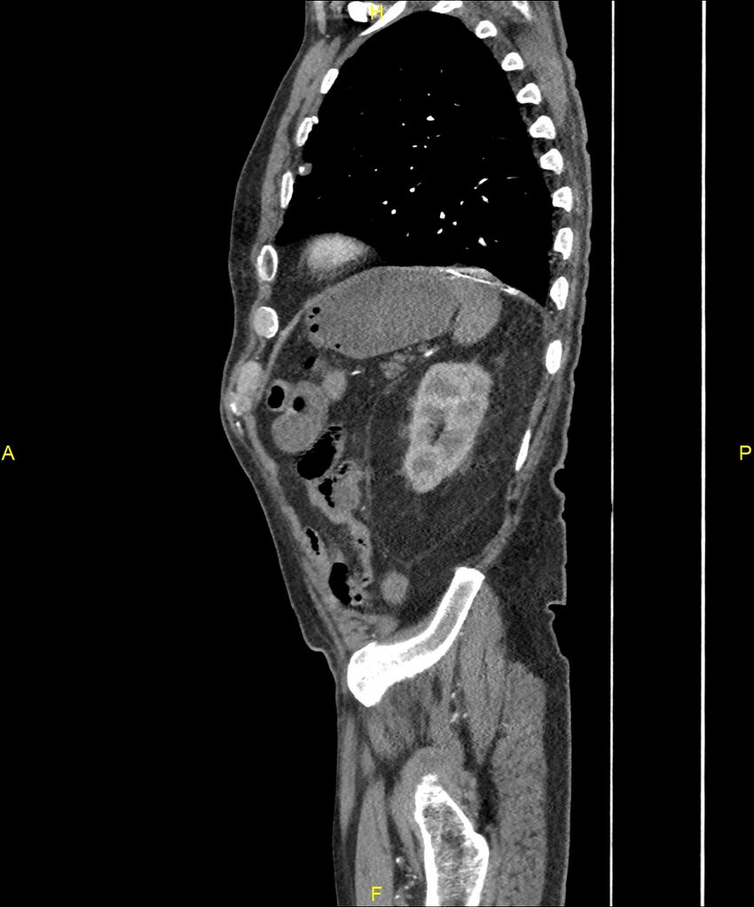 Aortoenteric fistula (Radiopaedia 84308-99603 C 273).jpg