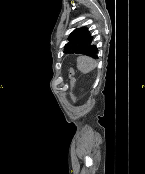 File:Aortoenteric fistula (Radiopaedia 84308-99603 C 307).jpg