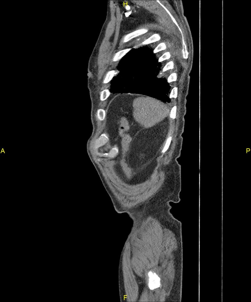 Aortoenteric fistula (Radiopaedia 84308-99603 C 307).jpg