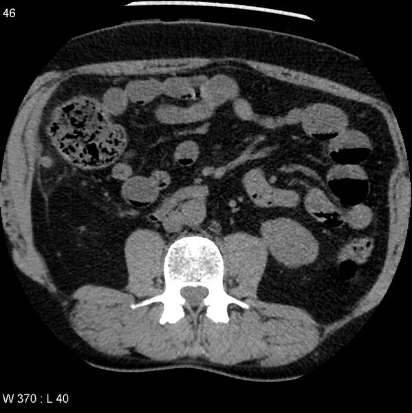 File:Appendicitis (Radiopaedia 12510-12733 Axial non-contrast 13).jpg