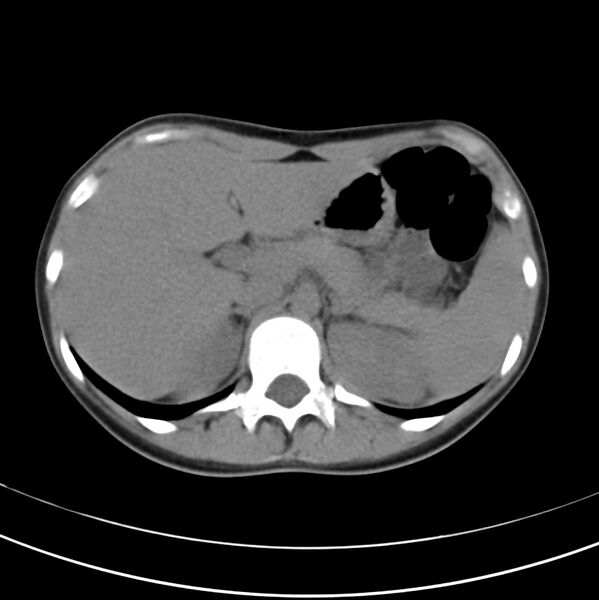 File:Appendicitis and incidental bicornuate uterus (Radiopaedia 22833-22853 Axial non-contrast 12).jpg
