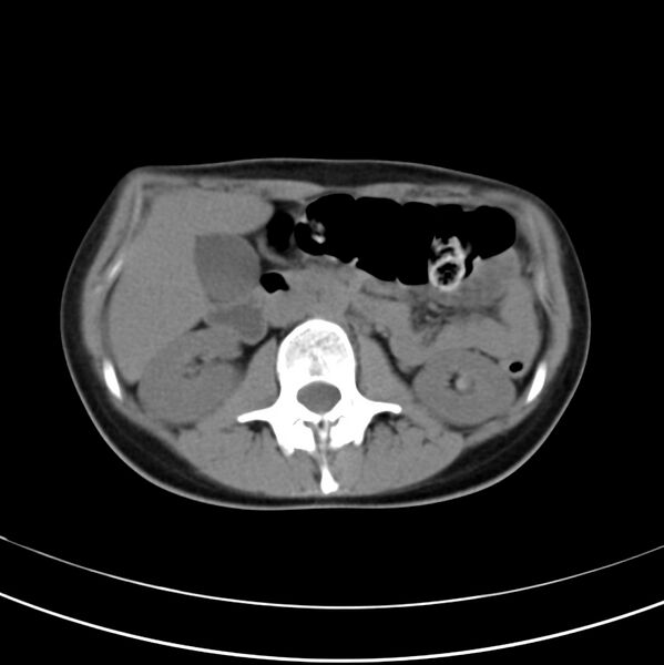 File:Appendicitis and incidental bicornuate uterus (Radiopaedia 22833-22853 Axial non-contrast 18).jpg