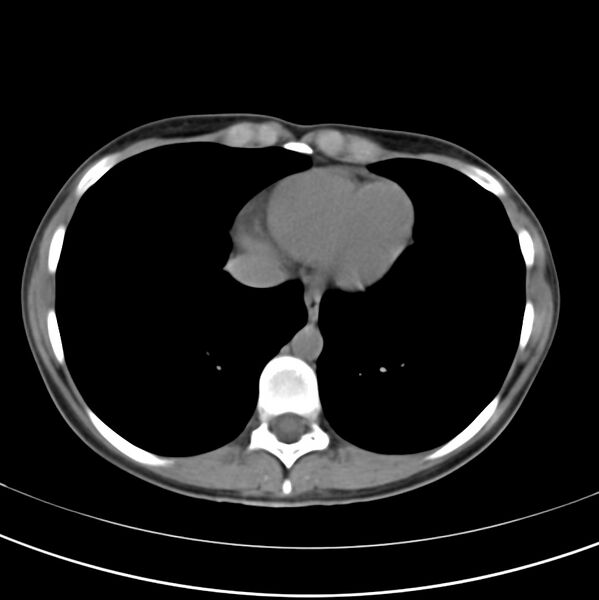 File:Appendicitis and incidental bicornuate uterus (Radiopaedia 22833-22853 Axial non-contrast 3).jpg