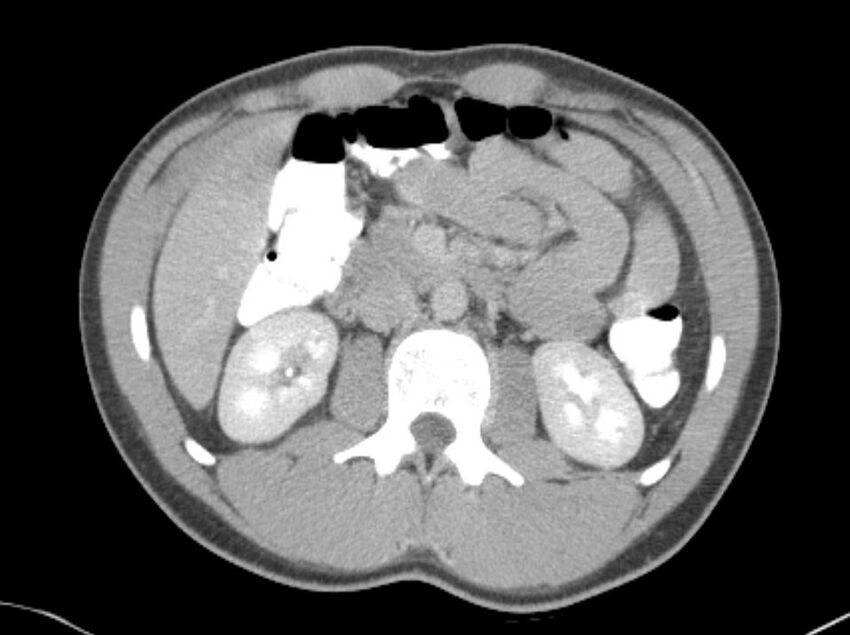 Appendicitis and incidental foregut duplication cyst (Radiopaedia 52962-58916 A 21).jpg