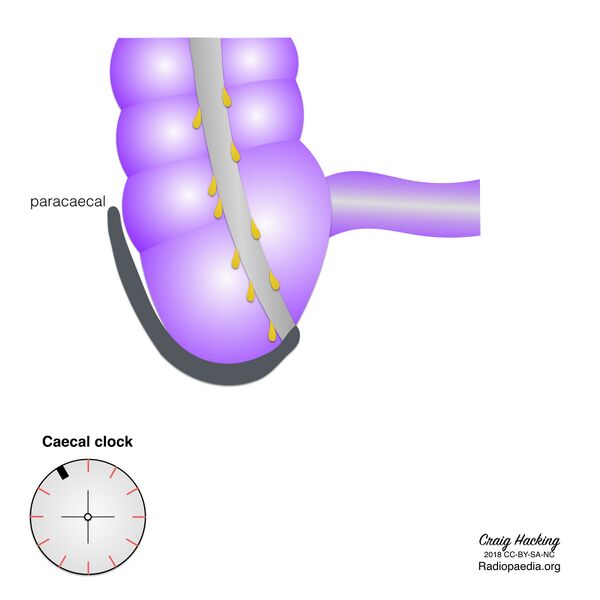 File:Appendix position (diagram) (Radiopaedia 62911-71293 C 7).jpeg