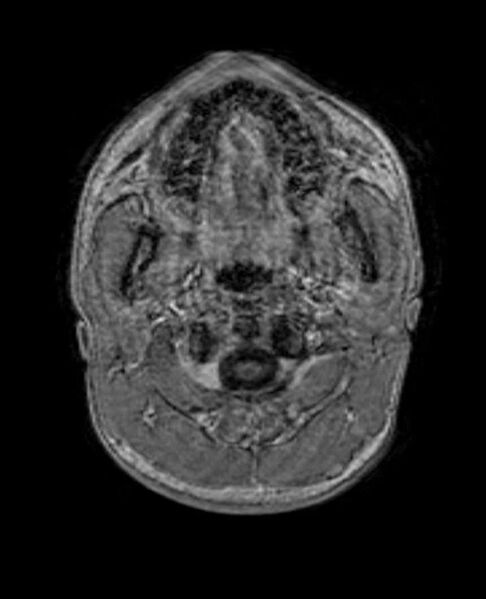 File:Arachnoid cyst- extremely large (Radiopaedia 68741-78451 Axial T1 C+ 1).jpg