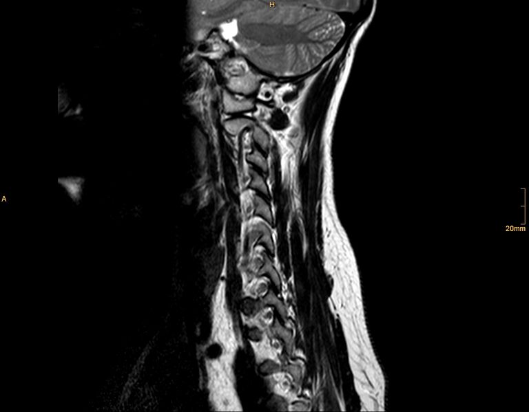 File:Arachnoid cyst - spinal (Radiopaedia 10055-10597 T2 6).jpg