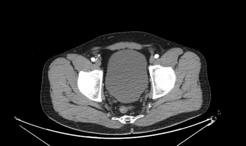 Arterial occlusive mesenteric ischemia (Radiopaedia 84641-100060 A 119).jpg