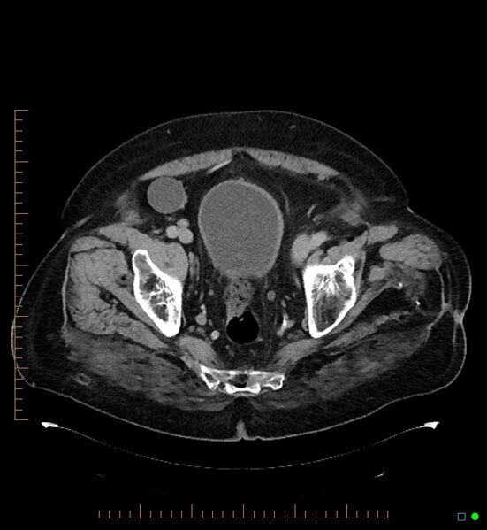 File:Artificial urethral sphincter (Radiopaedia 46937-51464 A 3).jpg