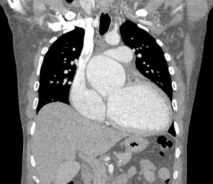 File:Ascending aortic aneurysm (Radiopaedia 86279-102297 B 27).jpg
