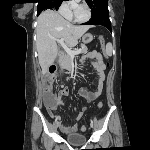File:Ascending retrocecal appendicitis with liver abscesses (Radiopaedia 60066-67615 C 25).jpg