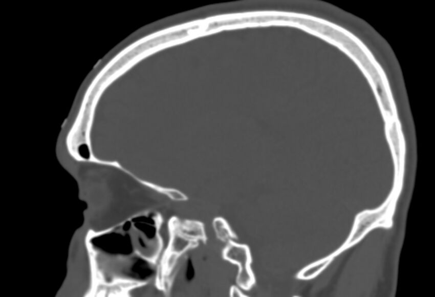 Asymptomatic occipital spur (Radiopaedia 87753-104201 Sagittal bone window 189).jpg