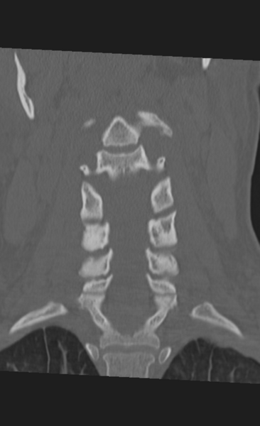 File:Atlanto-occipital dissociation (Radiopaedia 33848-35013 Coronal bone window 20).png