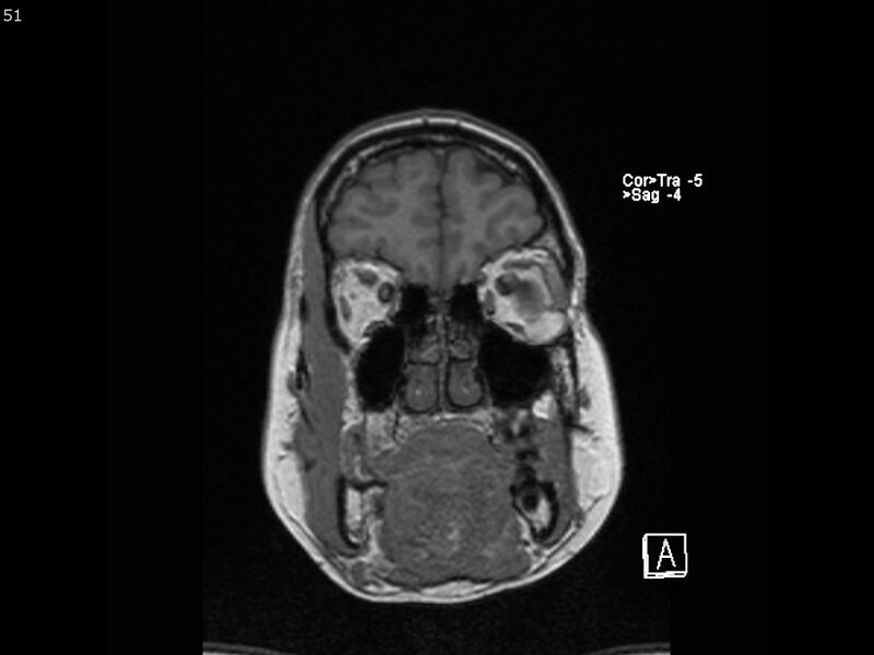 File:Atypical meningioma - intraosseous (Radiopaedia 64915-74572 Coronal T1 51).jpg