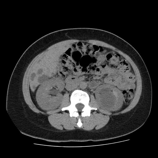 File:Autosomal dominant polycystic kidney disease (Radiopaedia 23061-23093 Axial non-contrast 31).jpg