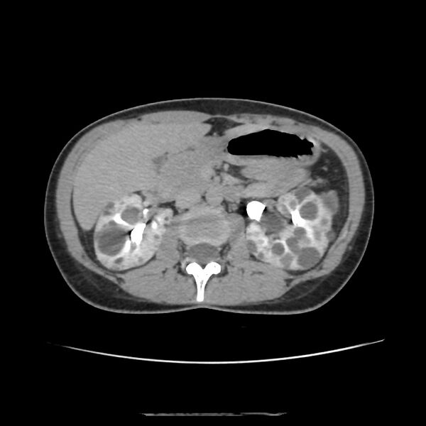 File:Autosomal dominant polycystic kidney disease - early onset (Radiopaedia 40734-43387 D 7).jpg