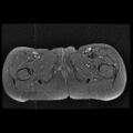 Avascular necrosis of the hip (Radiopaedia 29563-30067 Axial T1 C+ fat sat 18).jpg