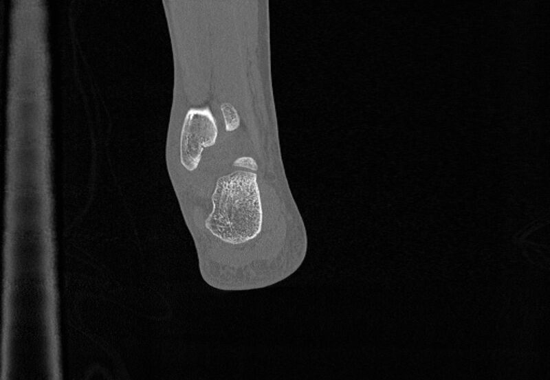 File:Avulsion fractures of talus and calcaneus (Radiopaedia 48277-53155 Coronal bone window 85).jpg