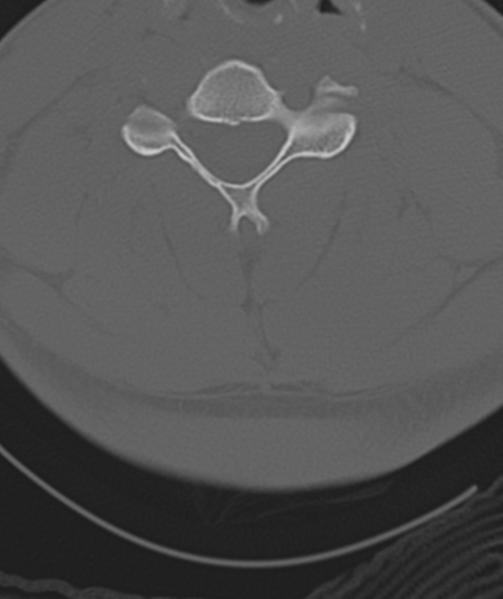 File:Axis peg fracture (type 3) and atlas lateral mass (type 4) fracture (Radiopaedia 37474-39324 Axial bone window 32).png