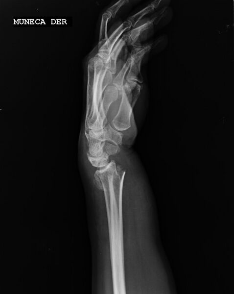 File:Barton fracture - dorsal type (Radiopaedia 79209-92210 Lateral 1).jpg