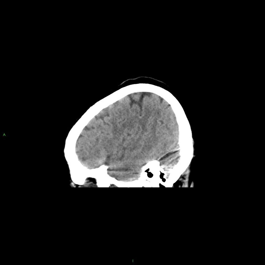 Basal ganglia hemorrhage (Radiopaedia 58349-65472 C 11).jpg