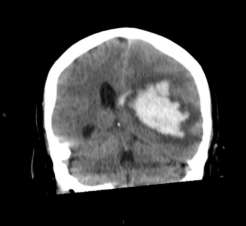 Basal ganglia hemorrhage (Radiopaedia 58759-65981 Coronal non-contrast 31).jpg