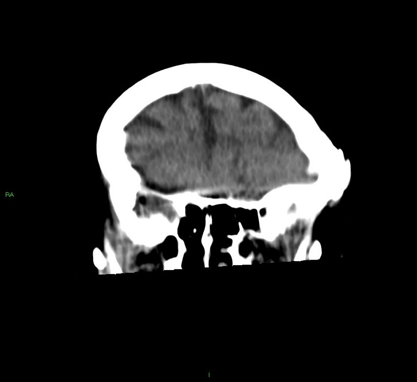 Basal ganglia hemorrhage (Radiopaedia 58790-66024 Coronal non-contrast 44).jpg