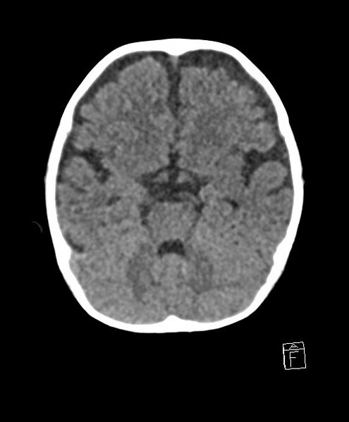 File:Benign enlargement of subarachnoid spaces in infancy (BESS) (Radiopaedia 87459-103795 Axial non-contrast 60).jpg
