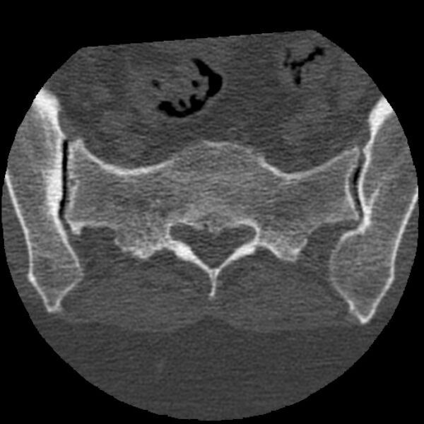 File:Bertolotti syndrome (Radiopaedia 24864-25128 Axial bone window 42).jpg