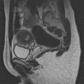 Bicornuate uterus (Radiopaedia 24677-24949 B 5).jpg