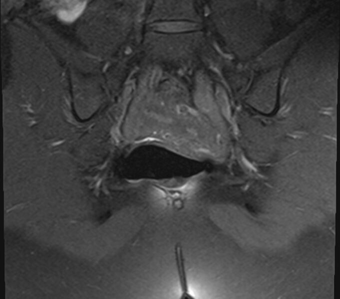 File:Bicornuate uterus (Radiopaedia 71214-81511 Coronal T1 fat sat 9).jpg