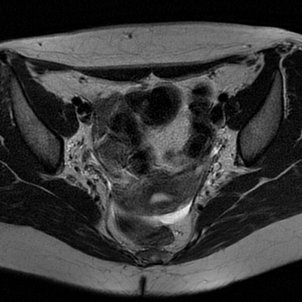File:Bicornuate uterus (Radiopaedia 72135-82643 Axial T2 10).jpg