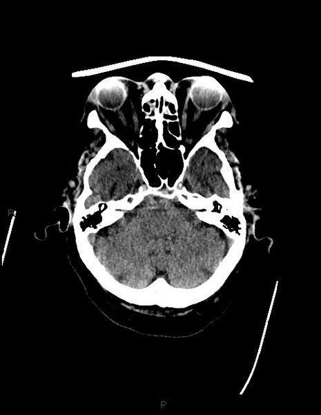 File:Bilateral acute middle cerebral artery territory infarcts (Radiopaedia 77319-89401 Axial non-contrast 20).jpg
