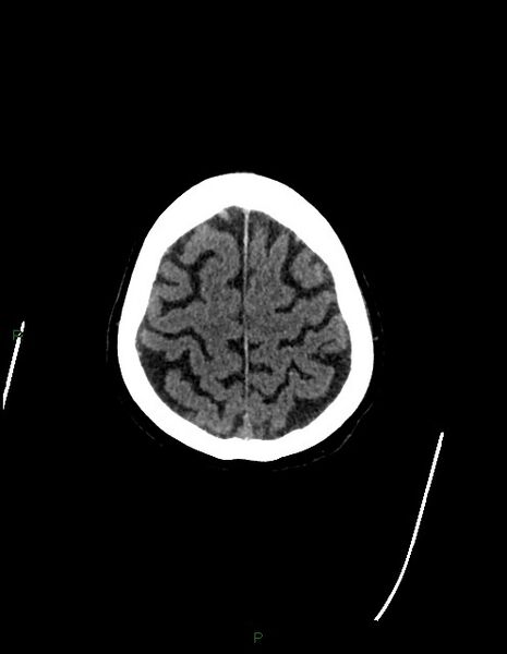 File:Bilateral acute middle cerebral artery territory infarcts (Radiopaedia 77319-89401 Axial non-contrast 77).jpg