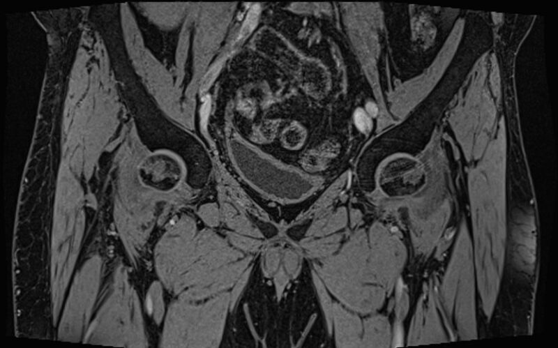 File:Bilateral avascular necrosis of femoral head (Radiopaedia 77116-89078 Coronal T2 we 67).jpg