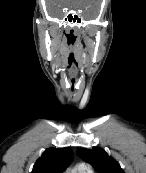 File:Bilateral carotid body tumors (Radiopaedia 52899-58827 B 1).jpg