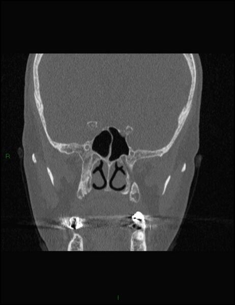 File:Bilateral frontal mucoceles (Radiopaedia 82352-96454 Coronal 205).jpg