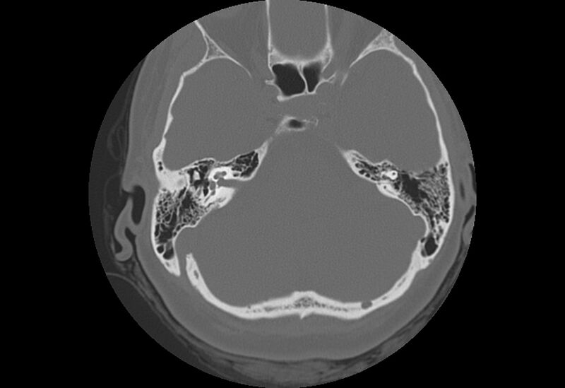 File:Bilateral otospongiosis (Radiopaedia 35447-36940 Axial bone window 34).jpg